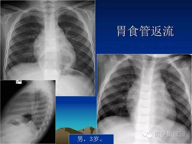 【PPT】膈疝的影像学诊断