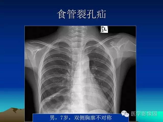 【PPT】膈疝的影像学诊断