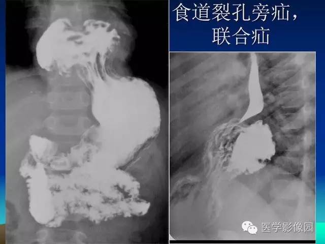 【PPT】膈疝的影像学诊断