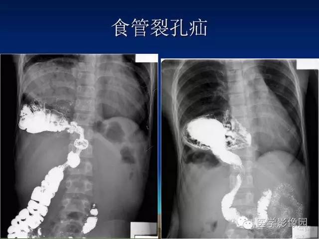 【PPT】膈疝的影像学诊断