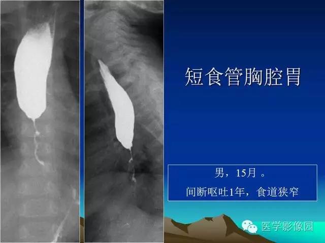 【PPT】膈疝的影像学诊断