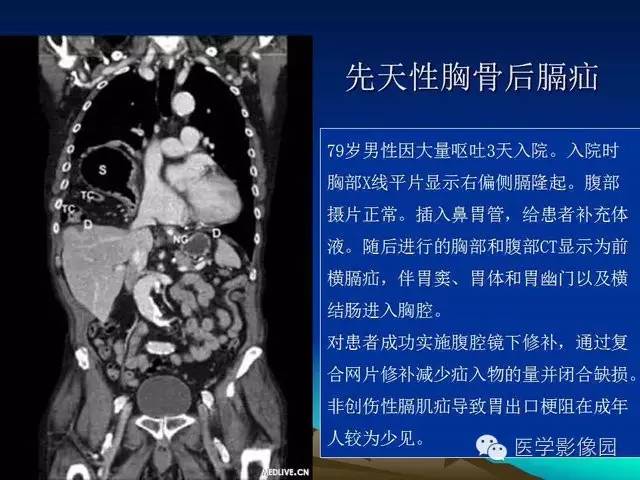 【PPT】膈疝的影像学诊断