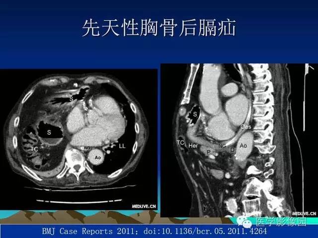 【PPT】膈疝的影像学诊断