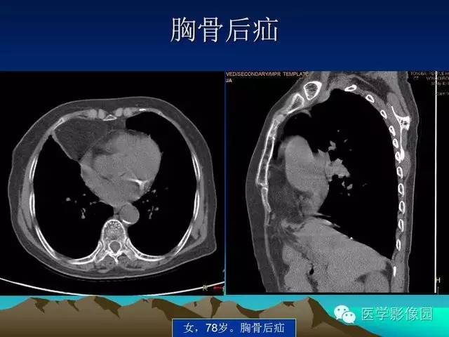 【PPT】膈疝的影像学诊断