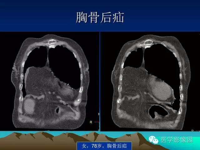 【PPT】膈疝的影像学诊断