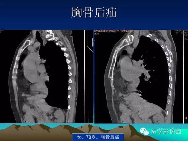 【PPT】膈疝的影像学诊断