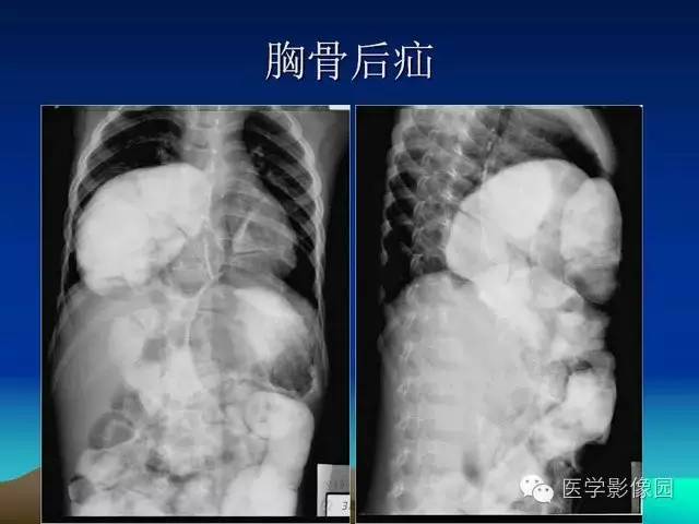 【PPT】膈疝的影像学诊断