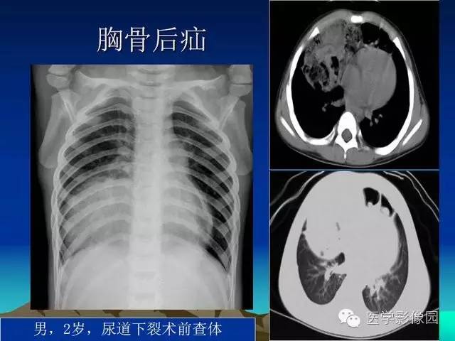 【PPT】膈疝的影像学诊断