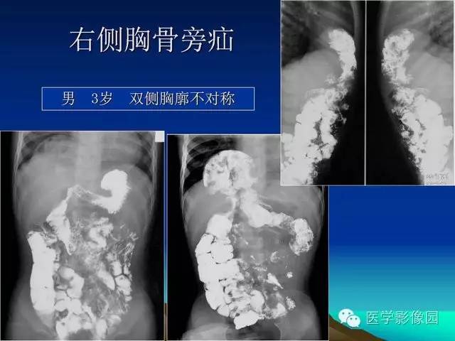 【PPT】膈疝的影像学诊断