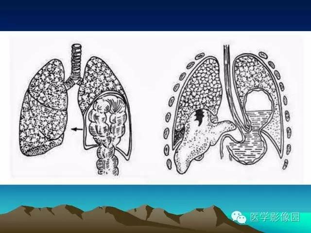 【PPT】膈疝的影像学诊断