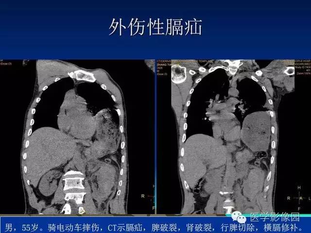 【PPT】膈疝的影像学诊断