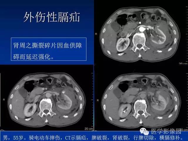 【PPT】膈疝的影像学诊断