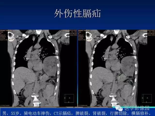 【PPT】膈疝的影像学诊断
