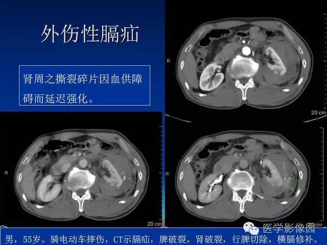 【PPT】膈疝的影像学诊断