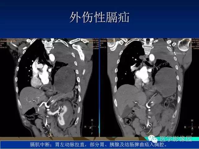 【PPT】膈疝的影像学诊断