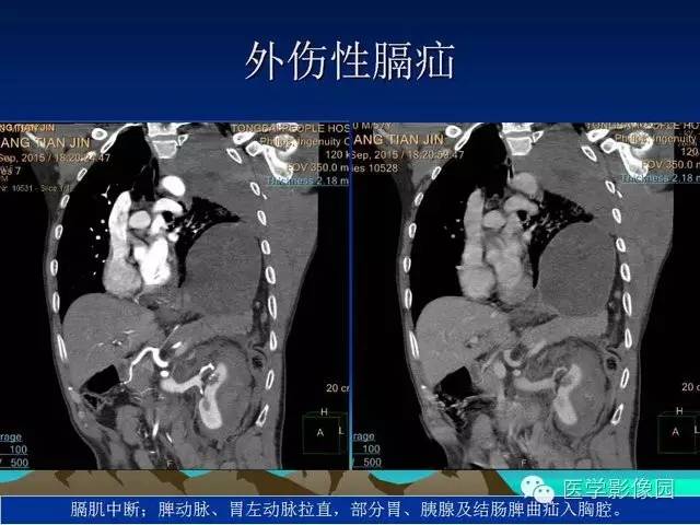 【PPT】膈疝的影像学诊断