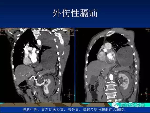 【PPT】膈疝的影像学诊断