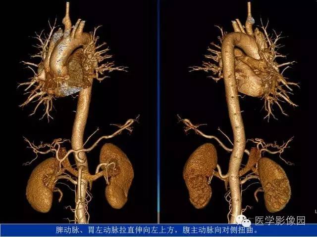 【PPT】膈疝的影像学诊断