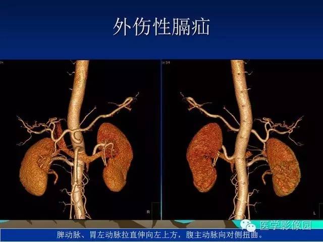 【PPT】膈疝的影像学诊断