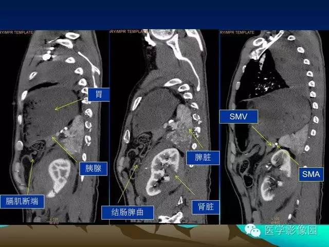 【PPT】膈疝的影像学诊断
