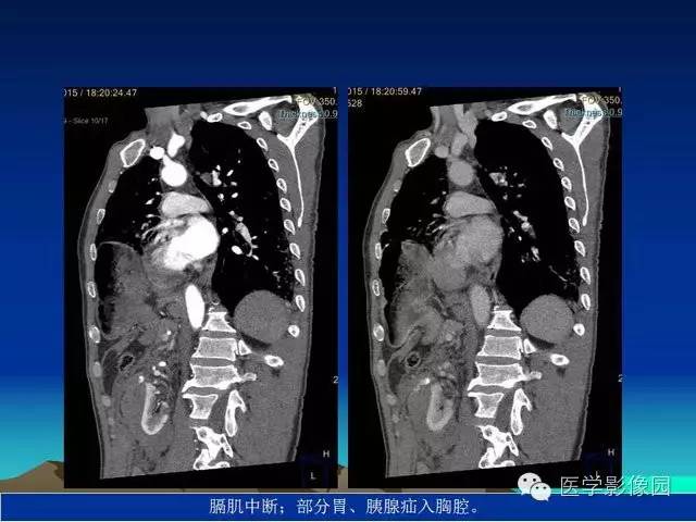【PPT】膈疝的影像学诊断