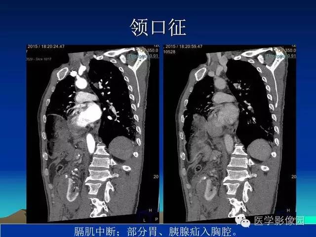 【PPT】膈疝的影像学诊断
