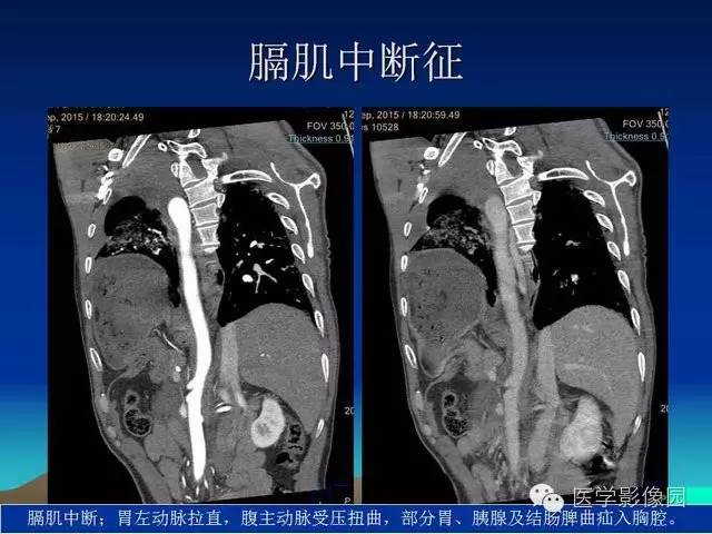 【PPT】膈疝的影像学诊断