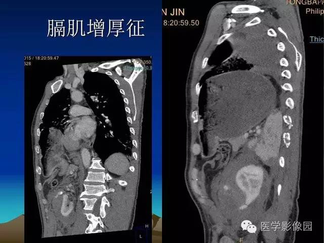 【PPT】膈疝的影像学诊断