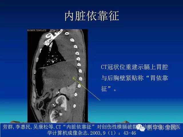 【PPT】膈疝的影像学诊断