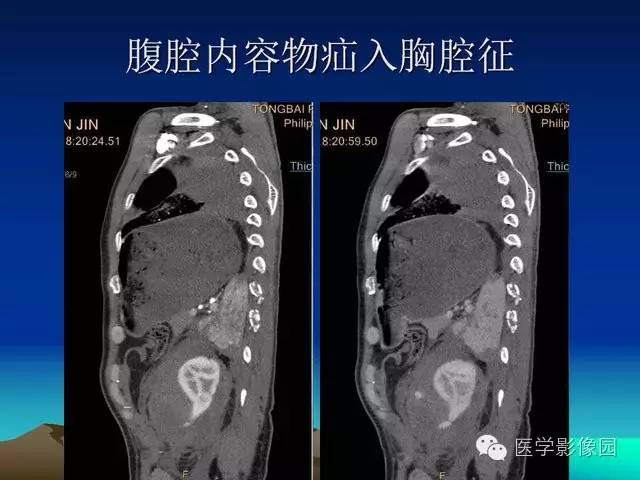 【PPT】膈疝的影像学诊断