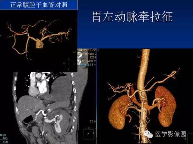 【PPT】膈疝的影像学诊断