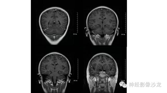 【病例】脑结核一例CT及MR影像表现