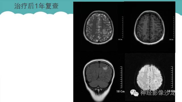 【病例】脑结核一例CT及MR影像表现