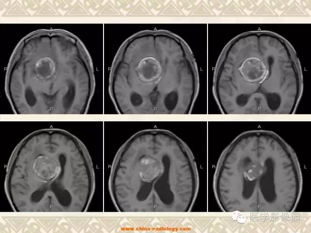 【病例】颅内动脉瘤伴血栓形成1例MR影像表现