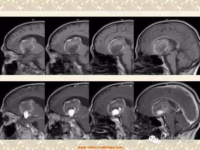 【病例】颅内动脉瘤伴血栓形成1例MR影像表现