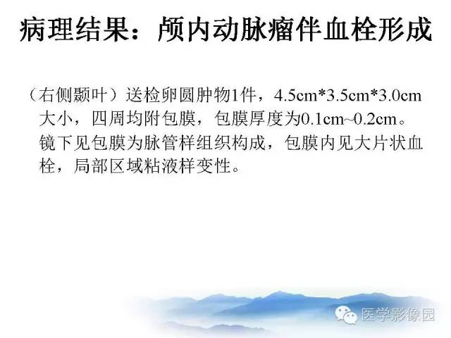 【病例】颅内动脉瘤伴血栓形成1例MR影像表现