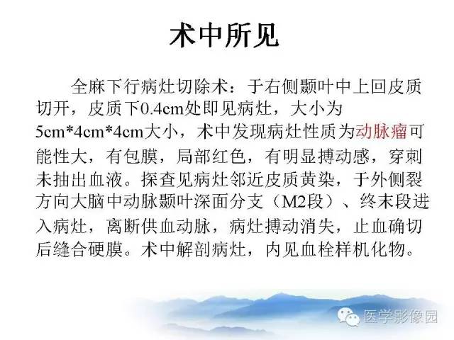 【病例】颅内动脉瘤伴血栓形成1例MR影像表现