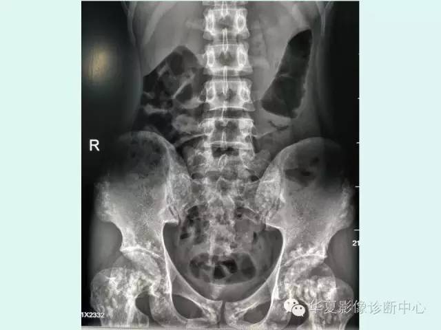 【病例】骨斑点症1例X线影像表现