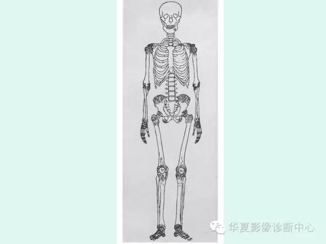 【病例】骨斑点症1例X线影像表现