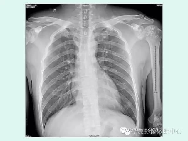 【病例】骨斑点症1例X线影像表现