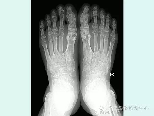 【病例】骨斑点症1例X线影像表现