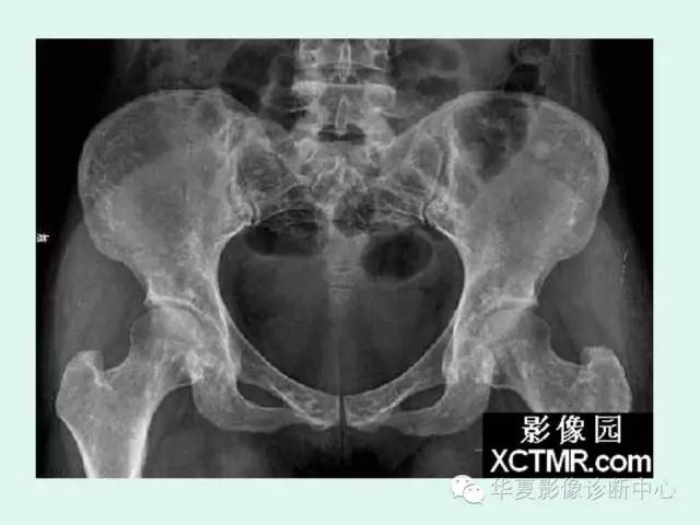 【病例】骨斑点症1例X线影像表现