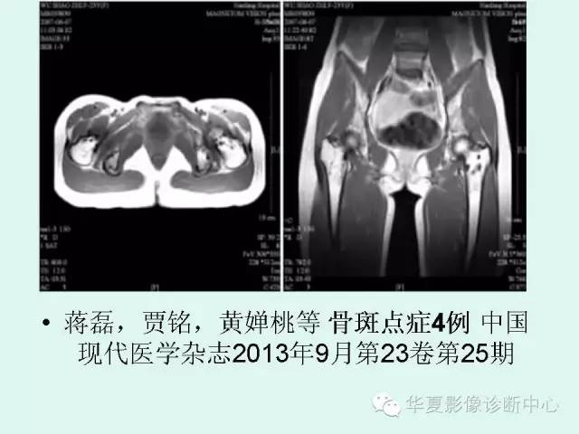 【病例】骨斑点症1例X线影像表现