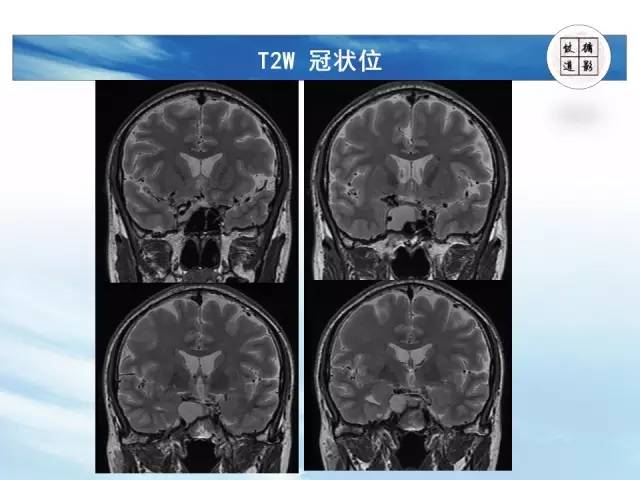 【病例】鞍区海绵状血管瘤1例MR影像表现与鉴别