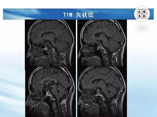 【病例】鞍区海绵状血管瘤1例MR影像表现与鉴别