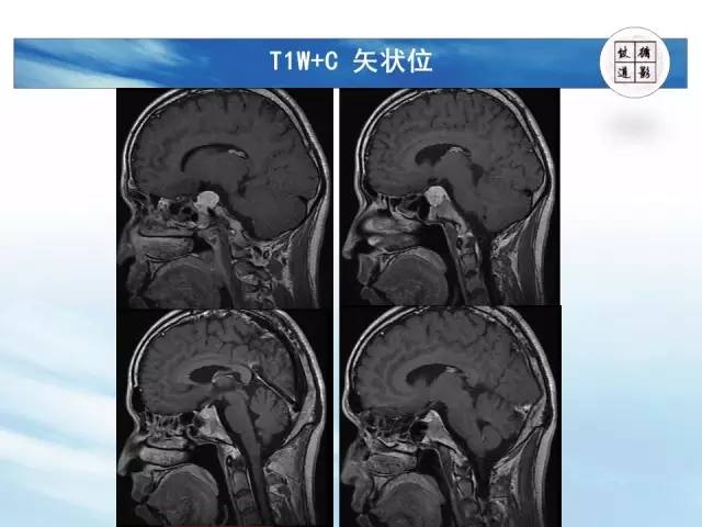 【病例】鞍区海绵状血管瘤1例MR影像表现与鉴别