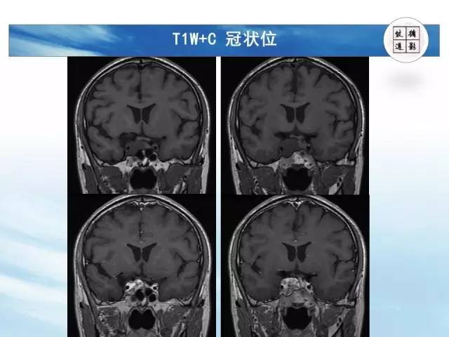 【病例】鞍区海绵状血管瘤1例MR影像表现与鉴别