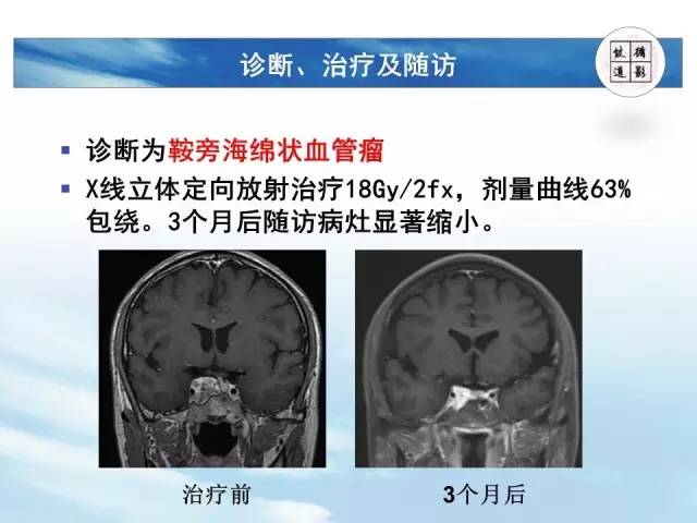 【病例】鞍区海绵状血管瘤1例MR影像表现与鉴别