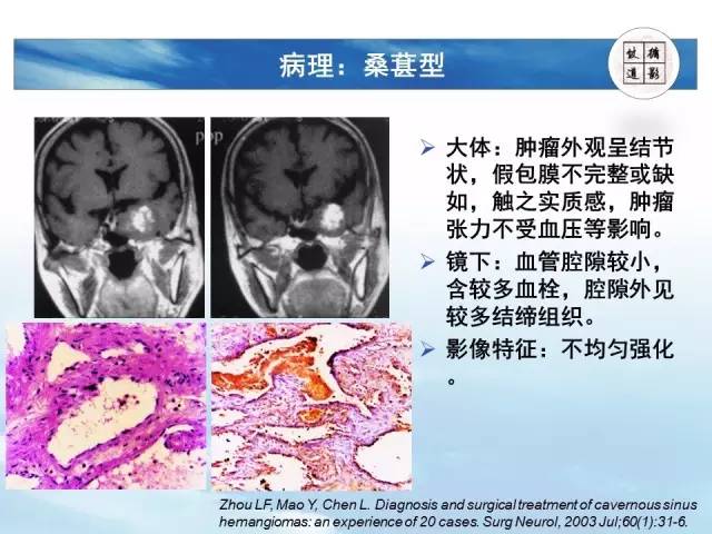 【病例】鞍区海绵状血管瘤1例MR影像表现与鉴别