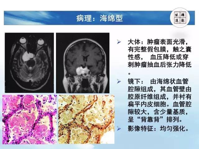 【病例】鞍区海绵状血管瘤1例MR影像表现与鉴别